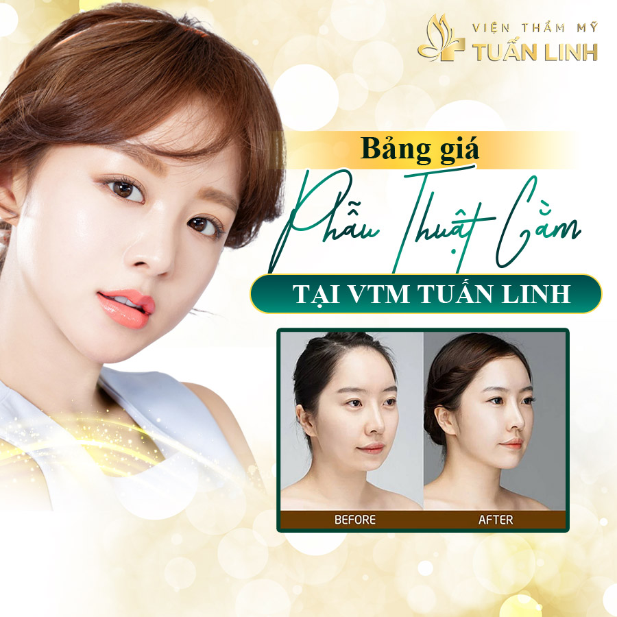 Độn cằm giá bao nhiêu? 15tr có ngay cằm đẹp hoàn mỹ