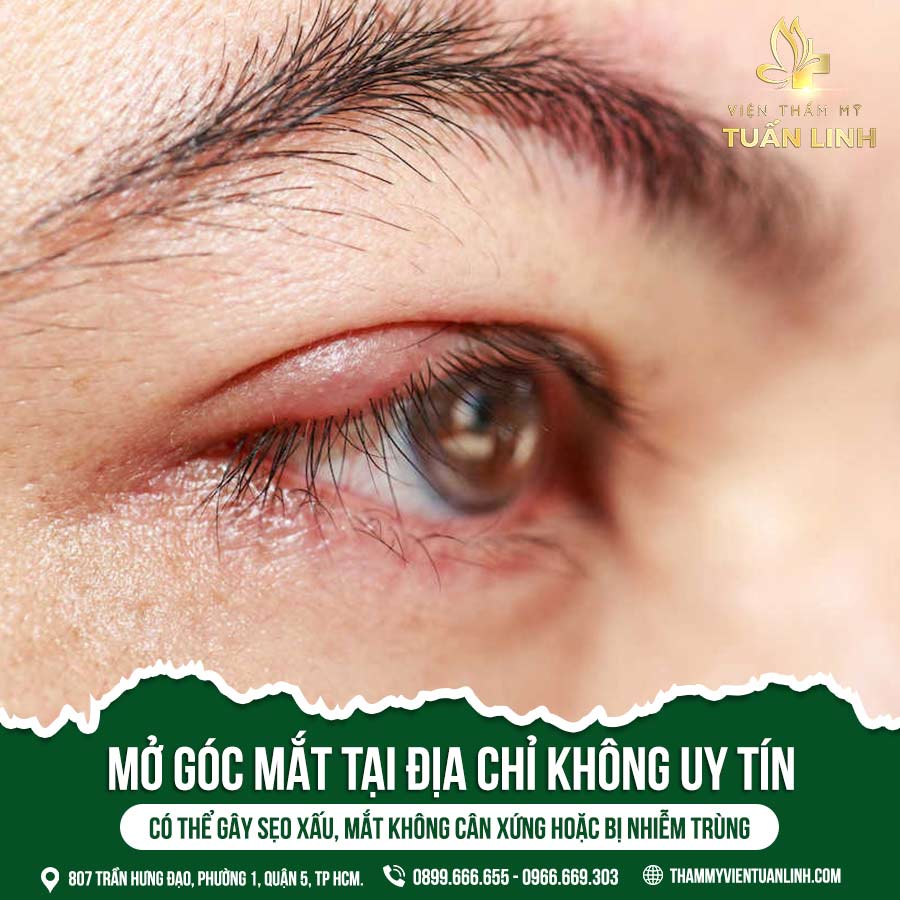 Mở góc mắt tại địa chỉ không uy tín có thể gây sẹo xấu, mắt không cân xứng hoặc bị nhiễm trùng | Mở rộng khóe mắt giúp bạn sở hữu đôi mắt to tròn lung linh