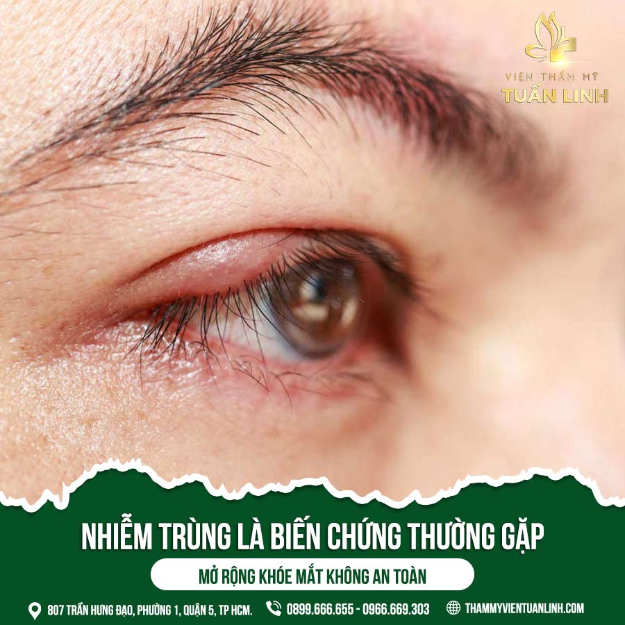 Nhiễm trùng là biến chứng thường gặp khi mở rộng khóe mắt không an toàn | Điểm mặt 5 tác hại của mở rộng góc mắt không an toàn