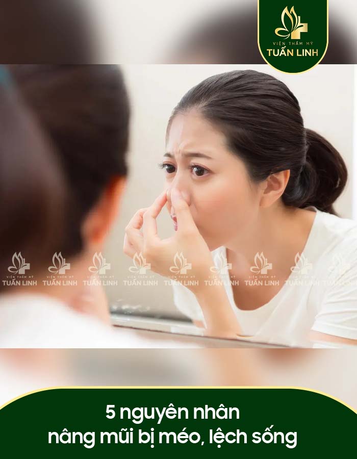 5 nguyên nhân nâng mũi bị méo, lệch sống