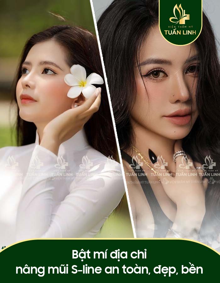 Bật mí địa chỉ nâng mũi S-line an toàn, đẹp, bền