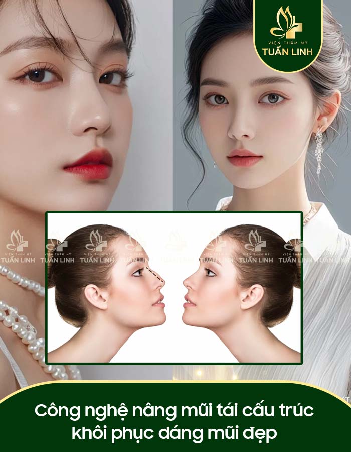 Công nghệ nâng mũi tái cấu trúc khôi phục dáng mũi đẹp