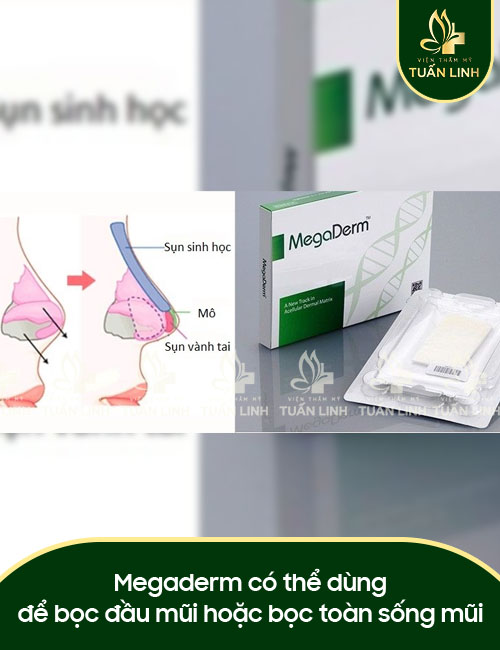 Megaderm có thể dùng để bọc đầu mũi hoặc bọc toàn sống mũi