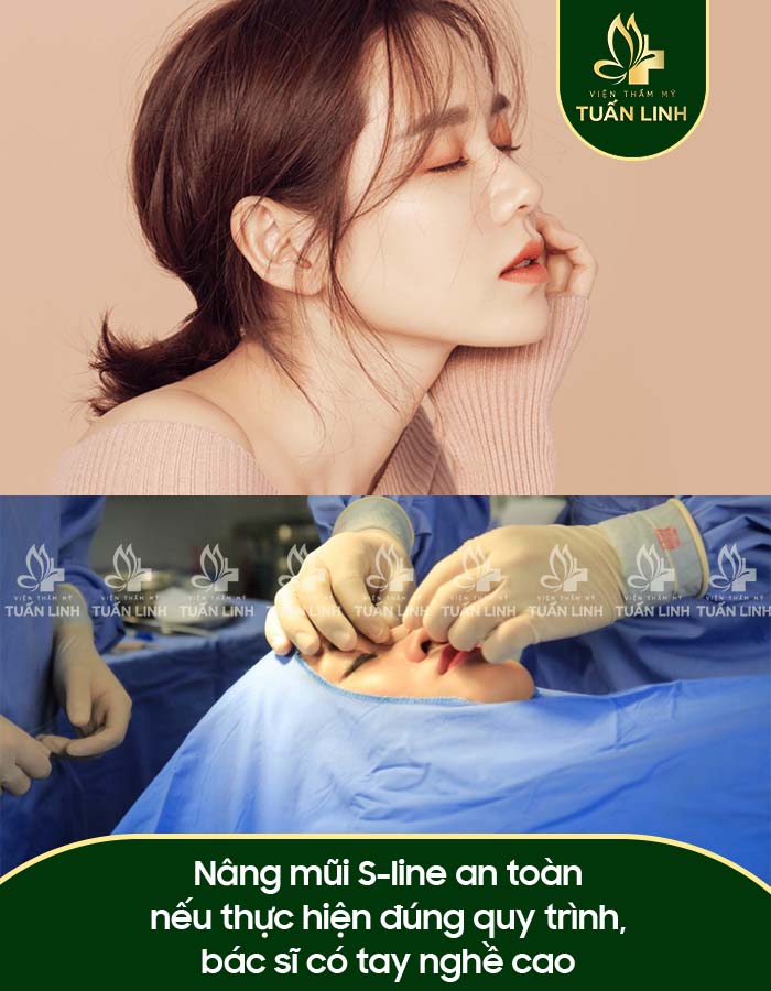 Nâng mũi S-line an toàn nếu thực hiện đúng quy trình, bác sĩ có tay nghề cao