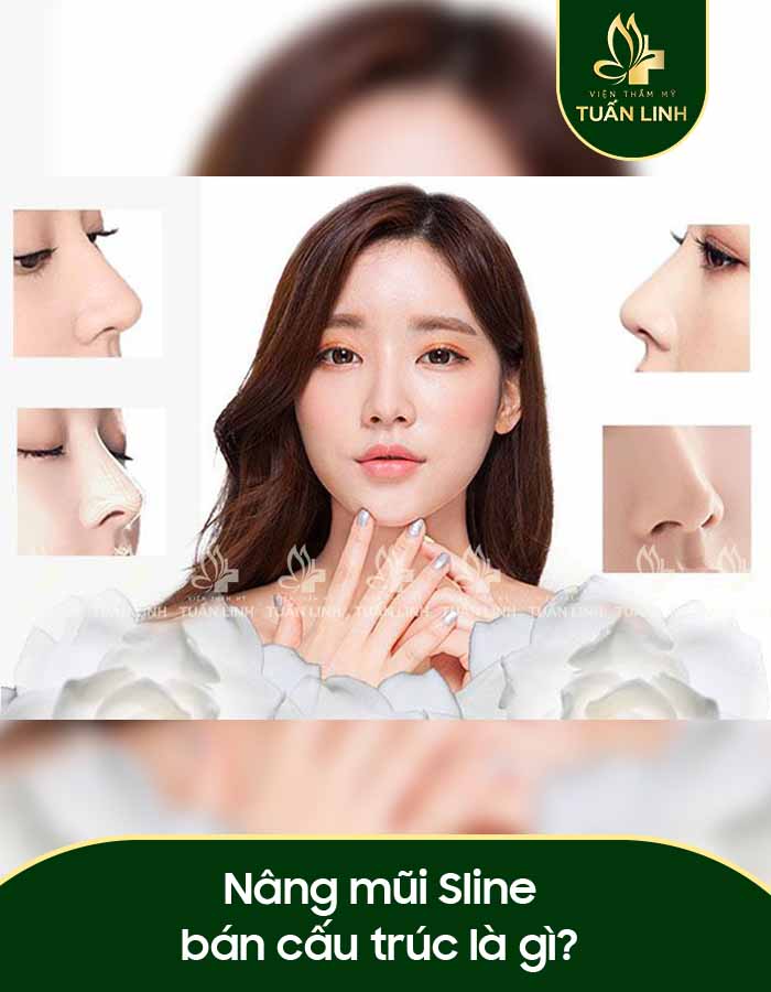 Nâng mũi Sline bán cấu trúc là gì?