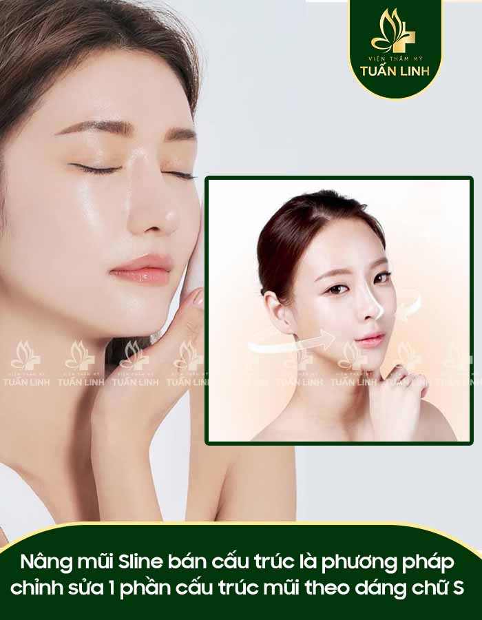 Nâng mũi Sline bán cấu trúc là phương pháp chỉnh sửa 1 phần cấu trúc mũi theo dáng chữ S