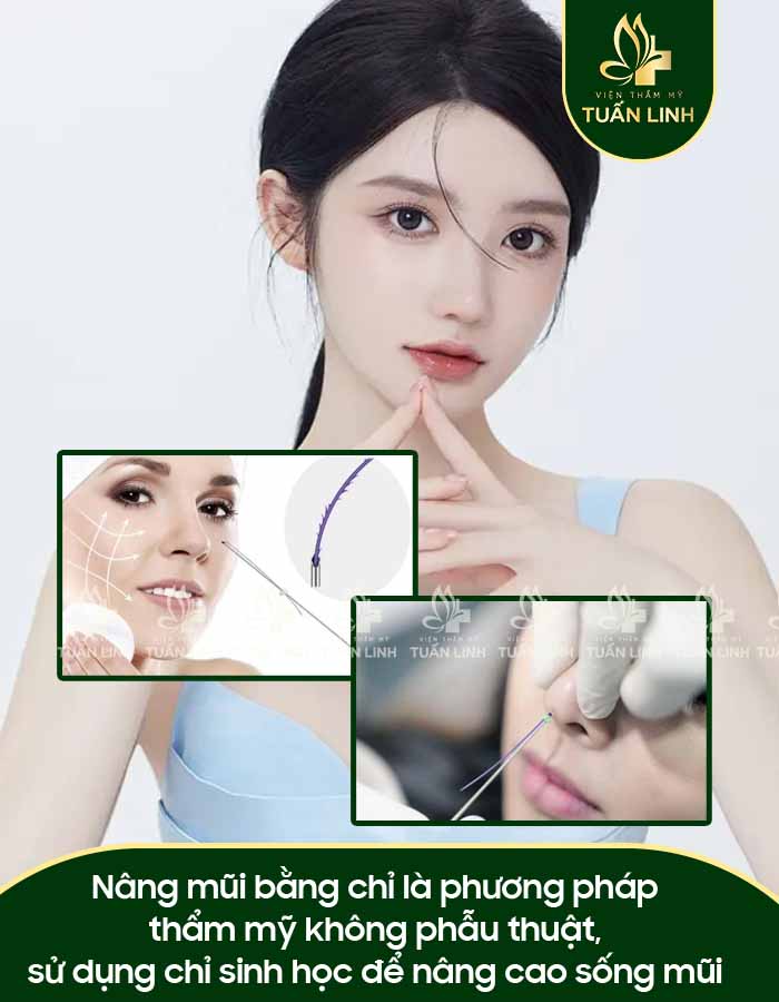Nâng mũi bằng chỉ là phương pháp thẩm mỹ không phẫu thuật, sử dụng chỉ sinh học để nâng cao sống mũi