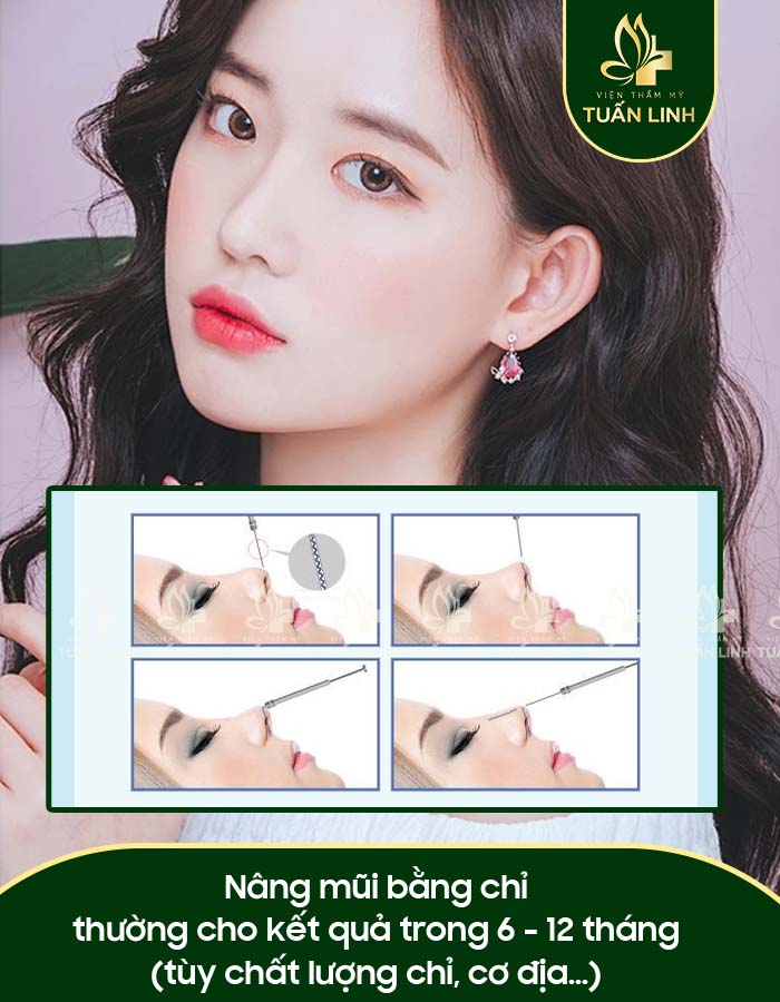 Nâng mũi bằng chỉ thường cho kết quả trong 6 - 12 tháng (tùy chất lượng chỉ, cơ địa...)