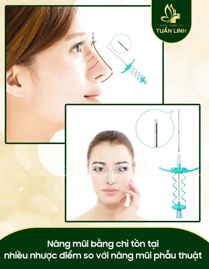 Nâng mũi bằng chỉ tồn tại nhiều nhược điểm so với nâng mũi phẫu thuật