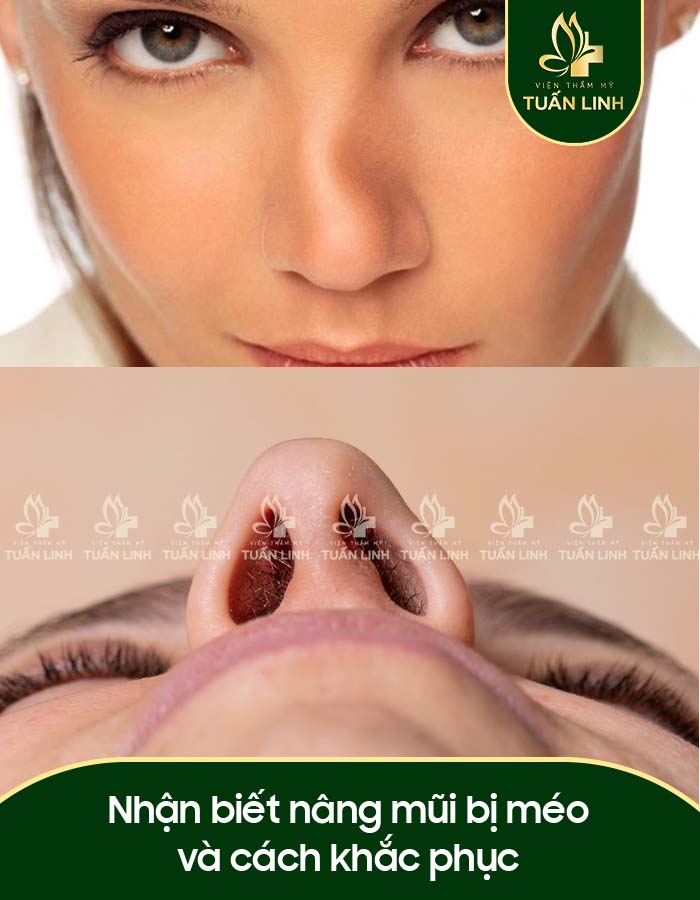 Nhận biết nâng mũi bị méo và cách khắc phục