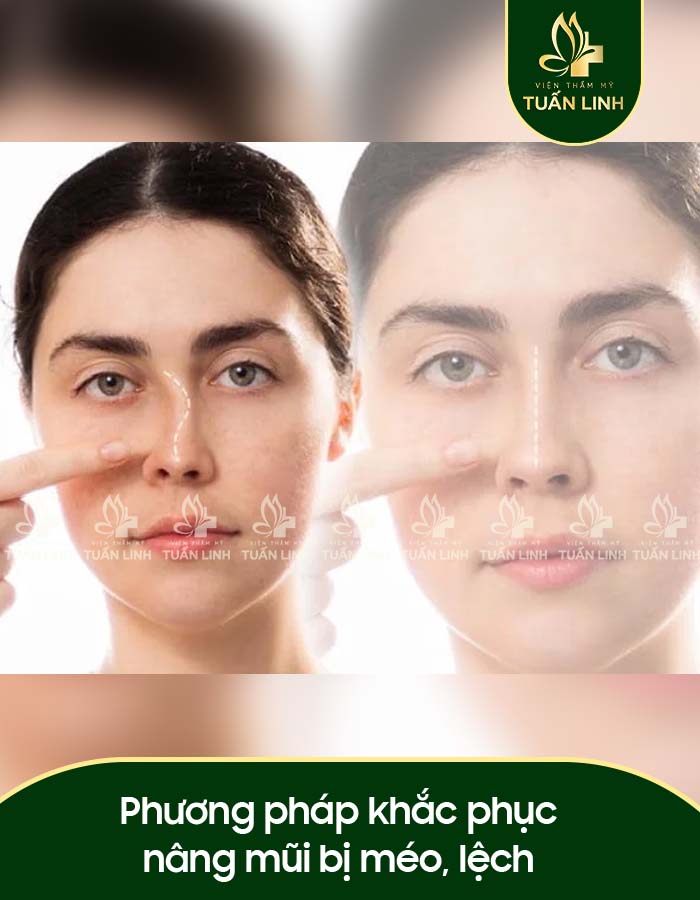 Phương pháp khắc phục nâng mũi bị méo, lệch