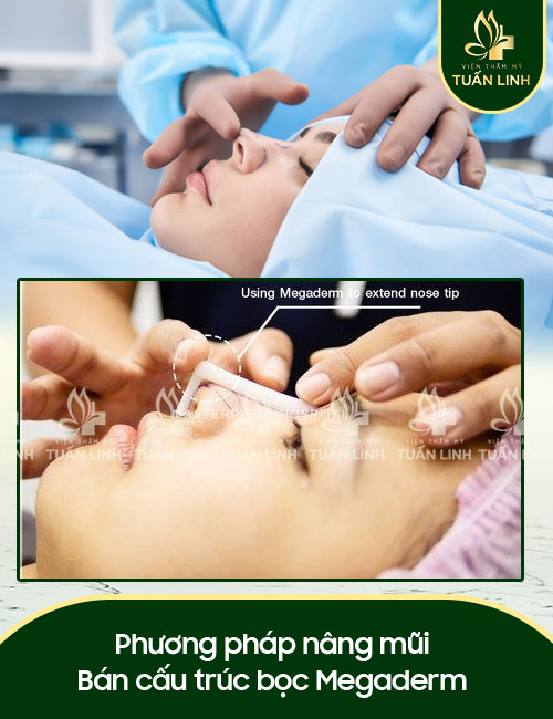 Phương pháp nâng mũi Bán cấu trúc bọc Megaderm