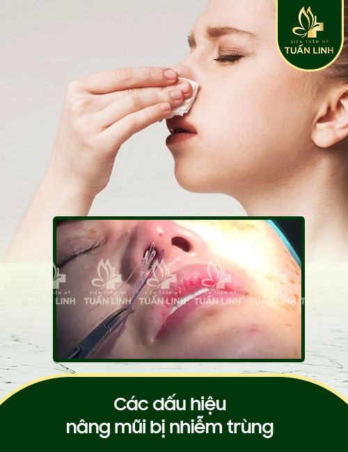 Các dấu hiệu nâng mũi bị nhiễm trùng