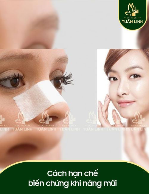 Cách hạn chế biến chứng khi nâng mũi