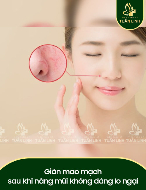 Giãn mao mạch sau khi nâng mũi không đáng lo ngại