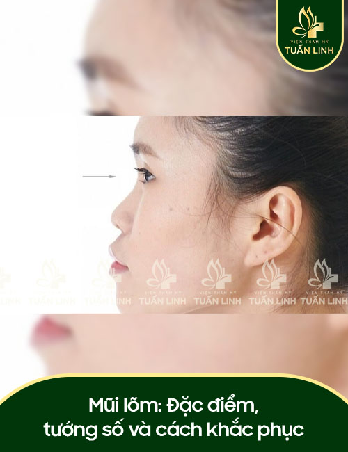 Mũi lõm: Đặc điểm, tướng số và cách khắc phục