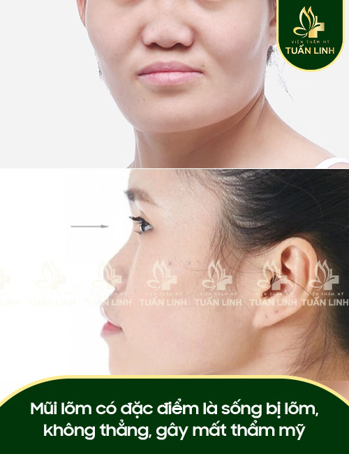 Mũi lõm có đặc điểm là sống bị lõm, không thẳng, gây mất thẩm mỹ