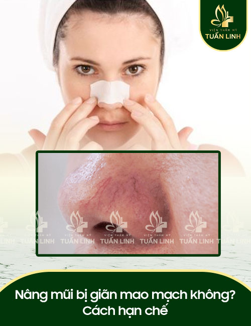 Nâng mũi bị giãn mao mạch không? Cách hạn chế