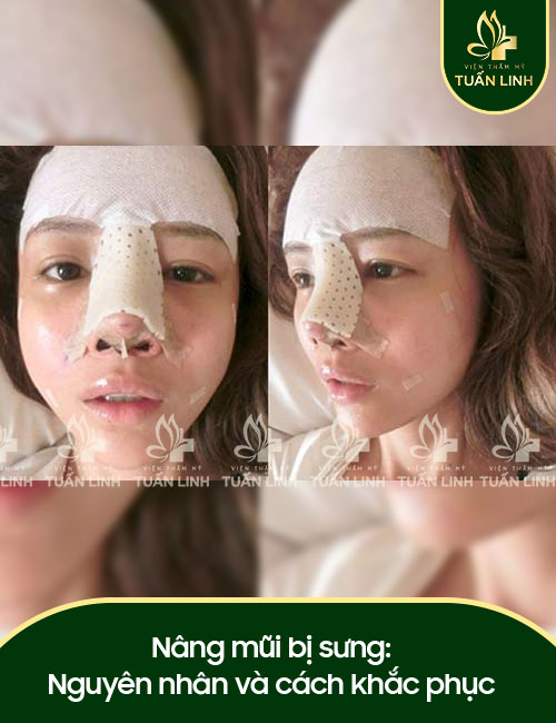 Nâng mũi bị sưng: Nguyên nhân và cách khắc phục