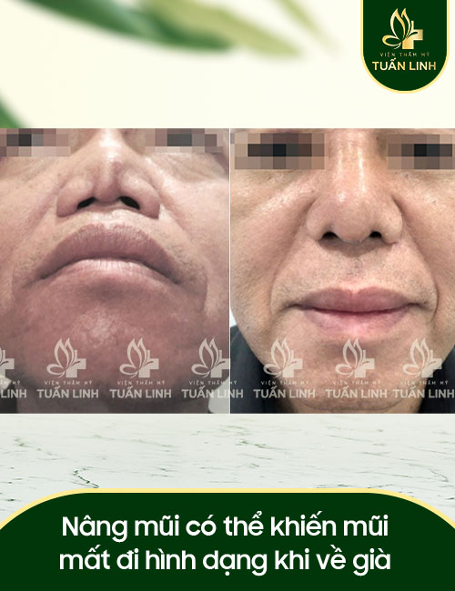 Nâng mũi có thể khiến mũi mất đi hình dạng khi về già