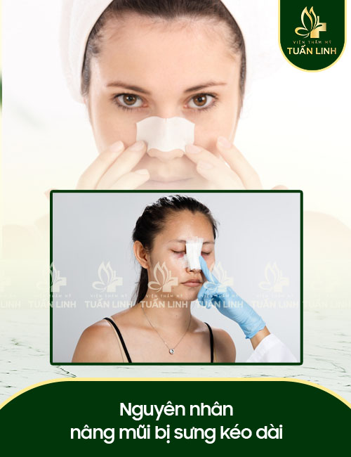 Nguyên nhân nâng mũi bị sưng kéo dài