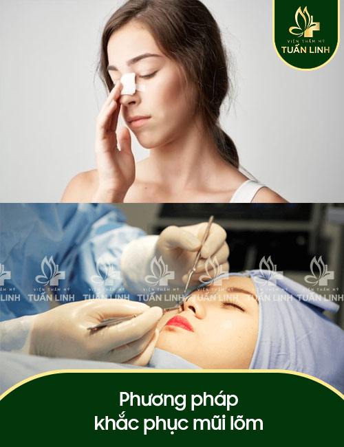 Phương pháp khắc phục mũi lõm