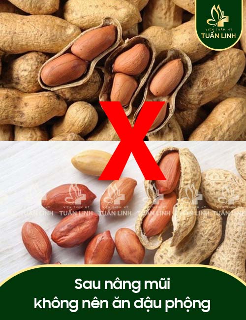 Sau nâng mũi không nên ăn đậu phộng
