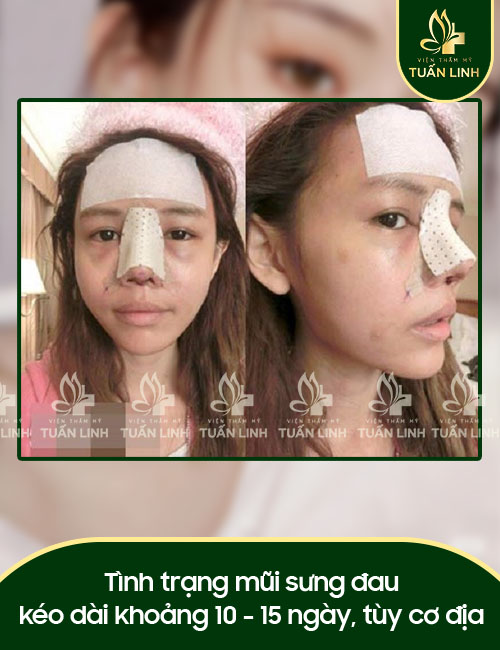 Tình trạng mũi sưng đau kéo dài khoảng 10 - 15 ngày, tùy cơ địa