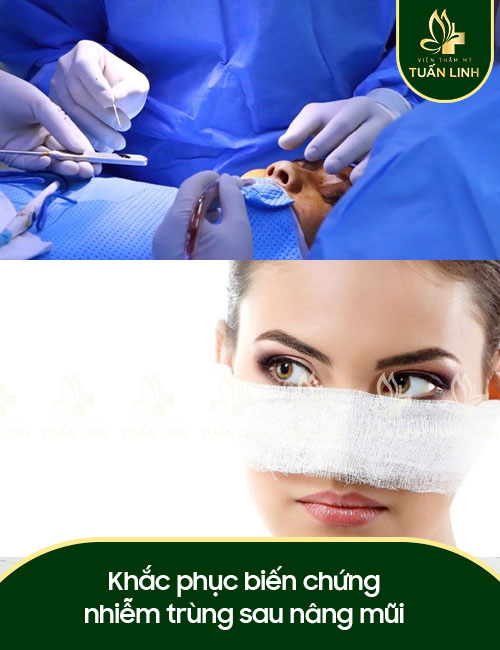 Khắc phục biến chứng nhiễm trùng sau nâng mũi