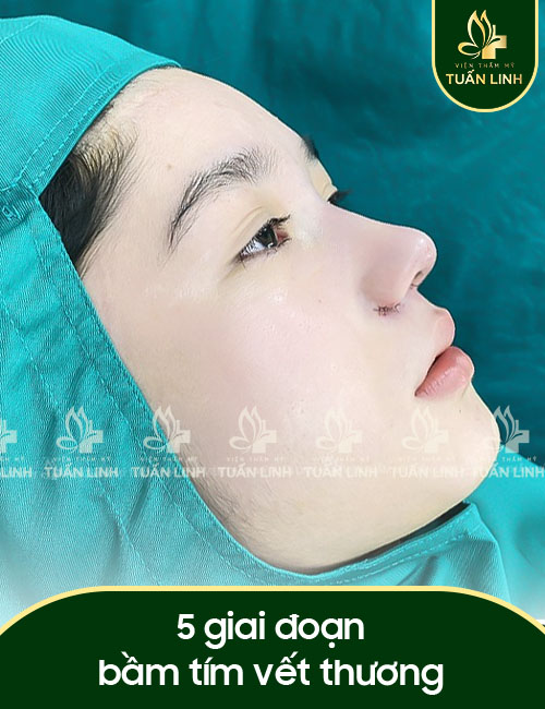 5 giai đoạn bầm tím vết thương