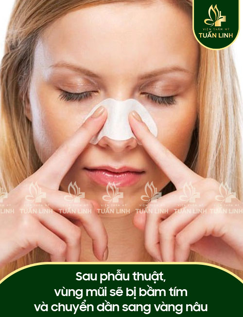 Sau phẫu thuật, vùng mũi sẽ bị bầm tím và chuyển dần sang vàng nâu