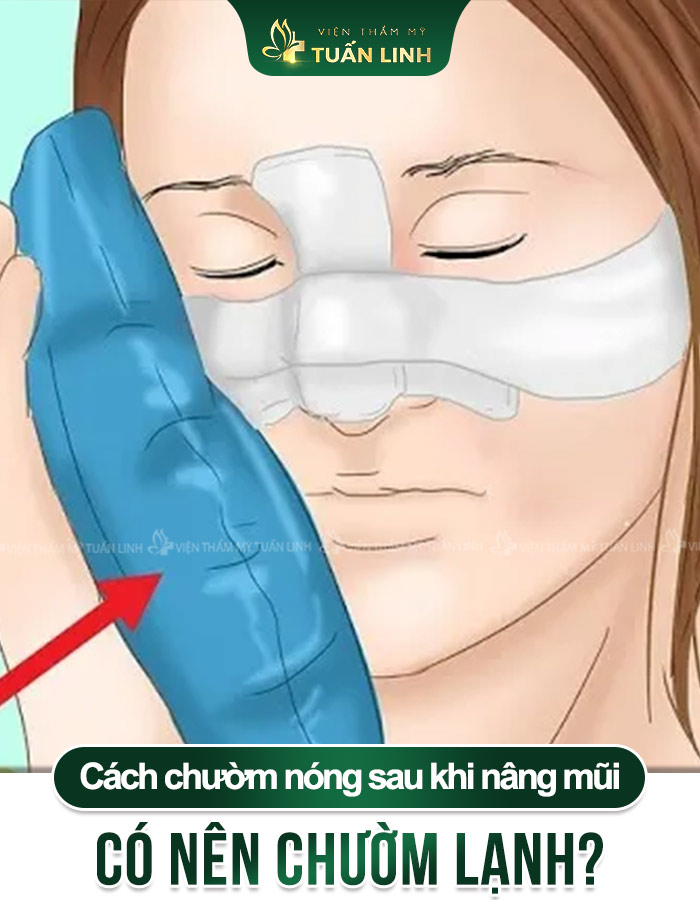 Cách chườm NÓNG sau khi nâng mũi - Có nên chườm Lạnh?