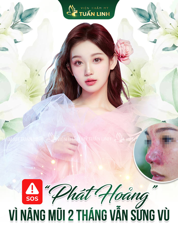 SOS - "Phát hoảng" vì nâng mũi 2 tháng vẫn SƯNG VÙ