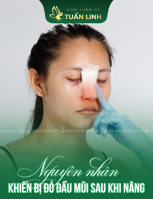 NGUYÊN NHÂN KHIẾN BỊ ĐỎ ĐẦU MŨI SAU KHI NÂNG