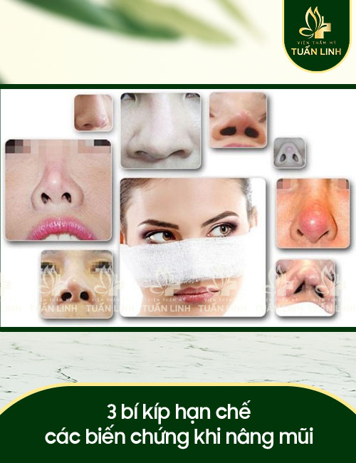 3 bí kíp hạn chế các biến chứng khi nâng mũi