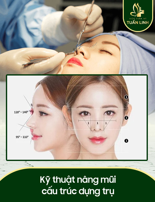 Kỹ thuật nâng mũi cấu trúc dựng trụ