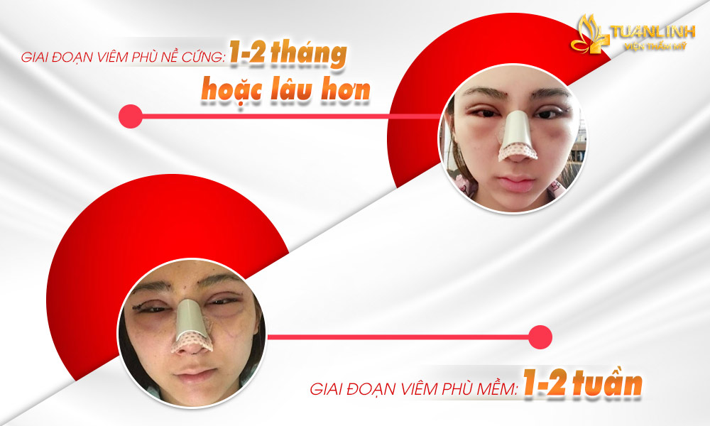 Các giai đoạn viêm phù nề