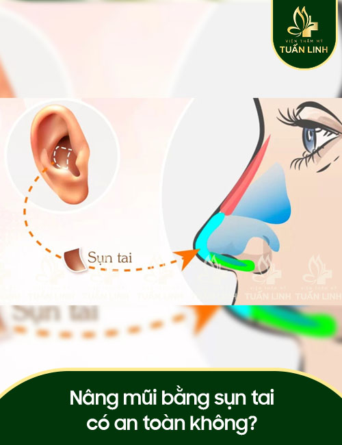 Nâng mũi bằng sụn tai có an toàn không?