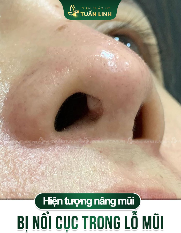 Hiện tượng nâng mũi bị nổi cục trong lỗ mũi