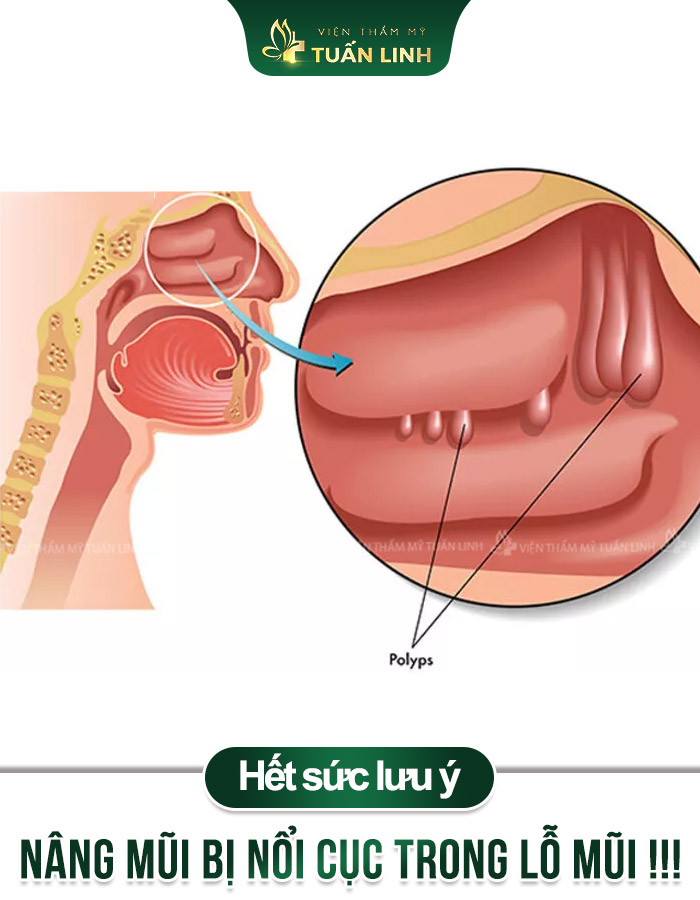 [Hết sức lưu ý] Nâng mũi bị Nổi Cục trong lỗ mũi !!!
