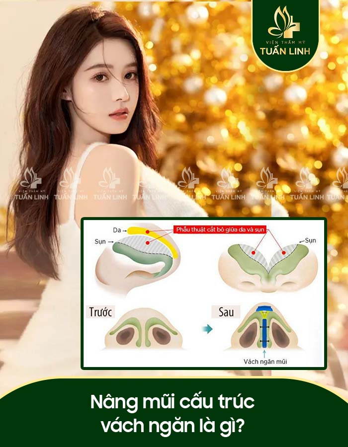 Nâng mũi cấu trúc vách ngăn là gì?