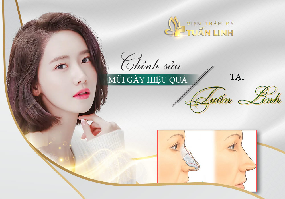 Chỉnh sửa mũi gãy hiệu quả tại Tuấn Linh | Tướng số người Mũi Gãy