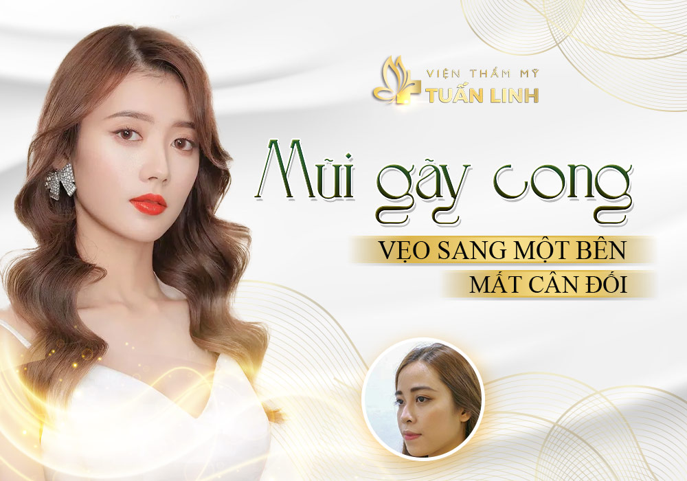 Mũi gãy cong, vẹo sang một bên, mất cân đối | Tướng số người Mũi Gãy