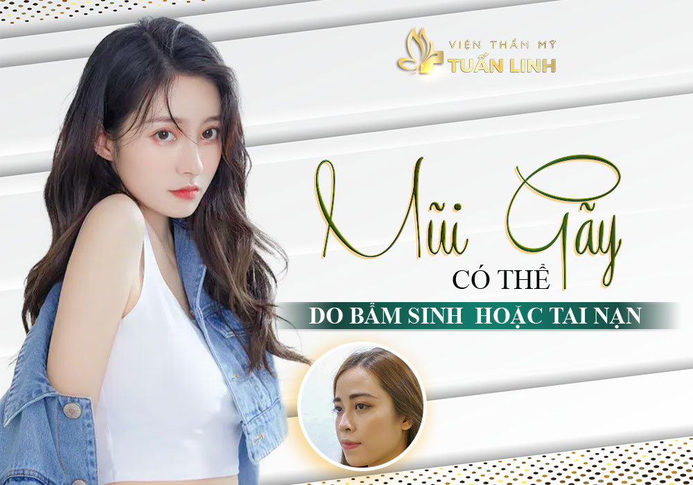 Mũi gãy có thể do bẩm sinh hoặc tai nạn | Tướng số người Mũi Gãy
