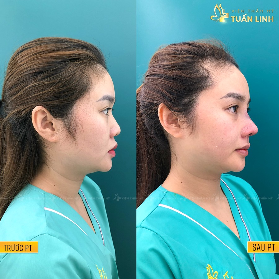 Trước - sau nâng mũi tại Tuấn Linh | Từ A - Z các loại Sụn Nâng Mũi tốt nhất hiện nay