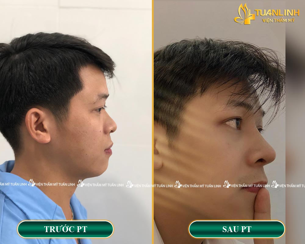 Hình ảnh khách hàng trước - sau khi NÂNG MŨI CHO NAM
