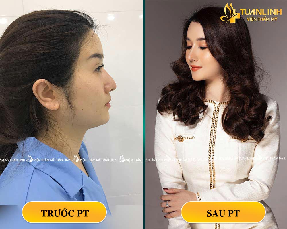 Hình ảnh mũi tái cấu trúc - KH Phương Linh