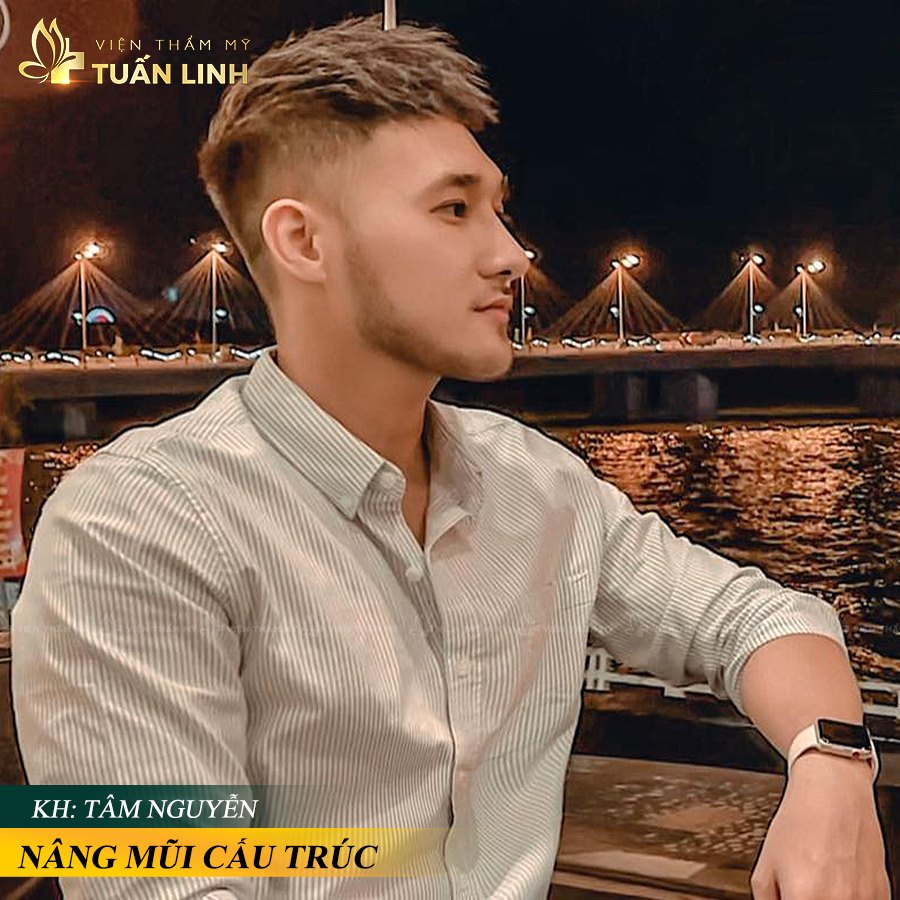 Hình ảnh sau nâng mũi của khách hàng