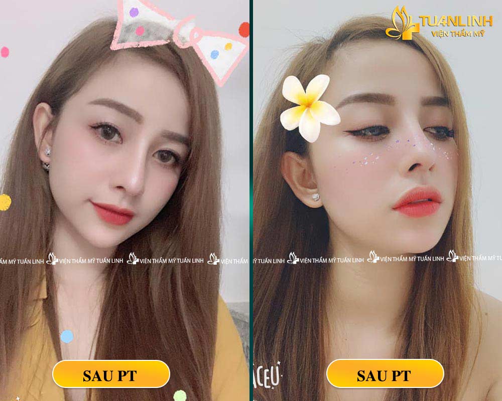 Hình ảnh khách hàng sau khi NÂNG MŨI BỌC MEGADERM