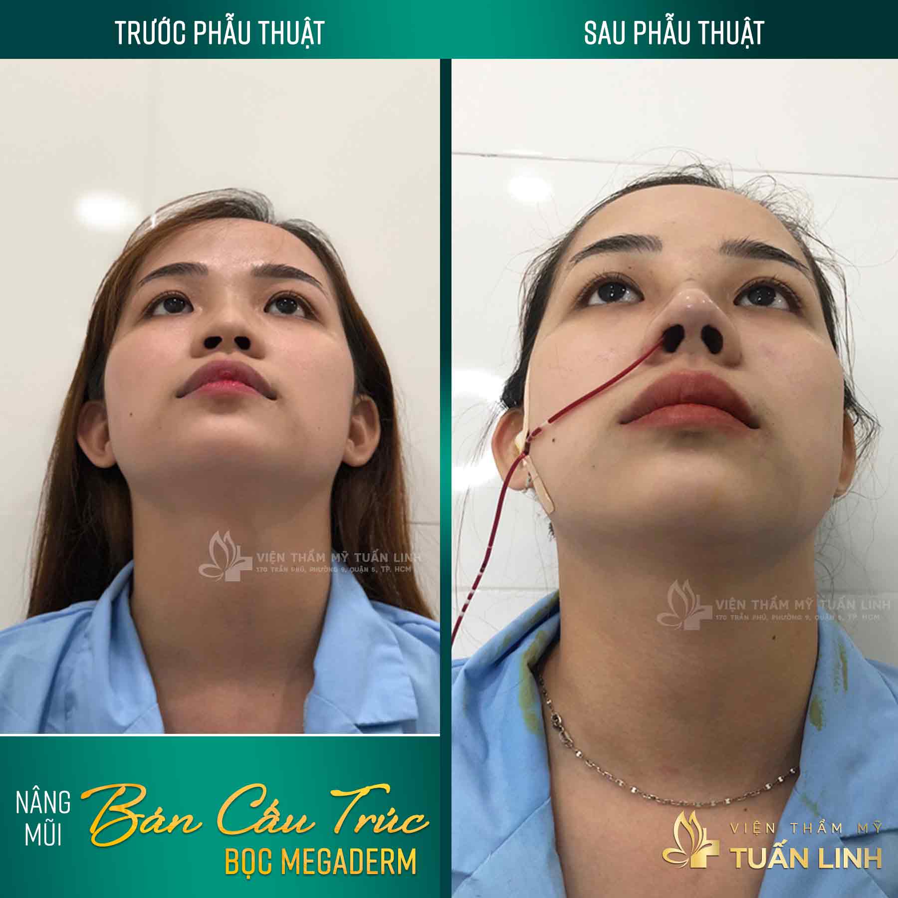 Hình ảnh khách hàng trước - sau khi NÂNG MŨI BỌC MEGADERM